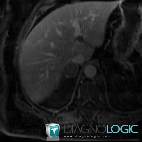 Adenoma, Adrenal glands, MRI