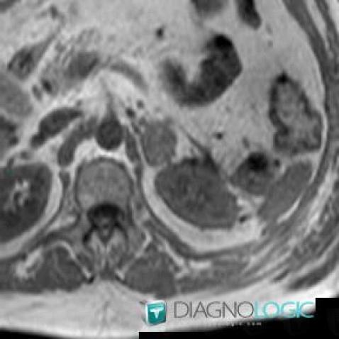 Adenoma, Adrenal glands, MRI