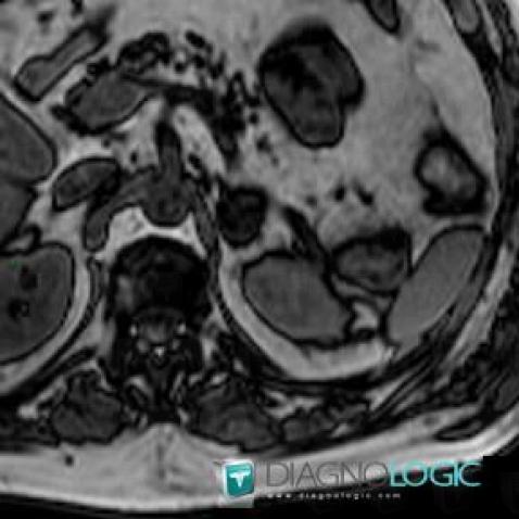 Adenoma, Adrenal glands, MRI