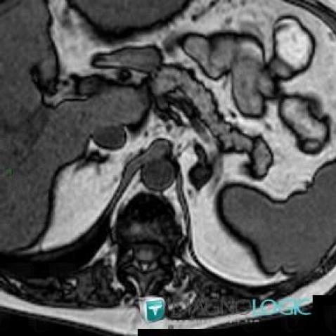 Radiology case : Adenoma (CT ,MRI) - Diagnologic