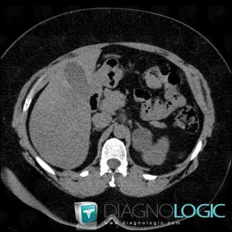 Adenoma, Retroperitoneum, CT