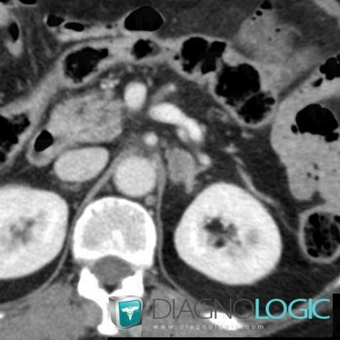 Adenoma, Retroperitoneum, CT