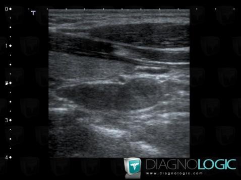 Adénome parathyroïdien, Espaces profonds-cou, Echographie