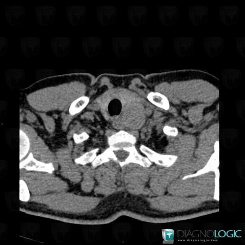 Adénome parathyroïdien, Espaces profonds-cou, Scanner