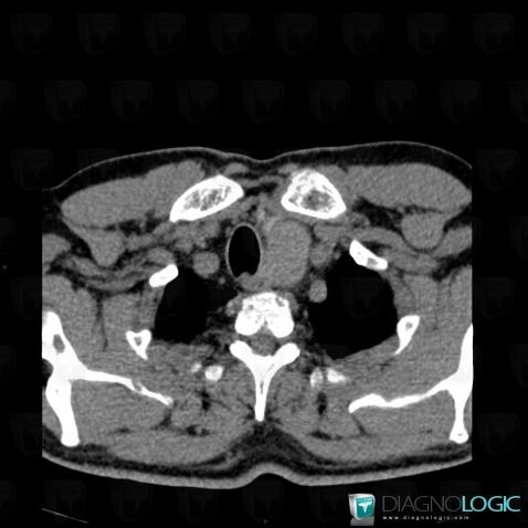 Adénome parathyroïdien, Médiastin, Scanner