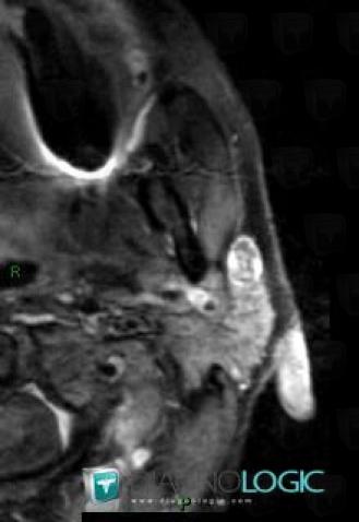 Adénome pléomorphe, Parotide et autres glandes salivaires, IRM