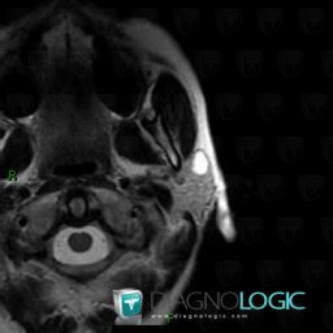 Adénome pléomorphe, Parotide et autres glandes salivaires, IRM