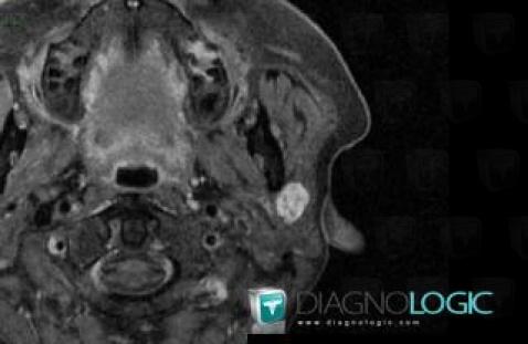 Adénome pléomorphe, Parotide et autres glandes salivaires, IRM