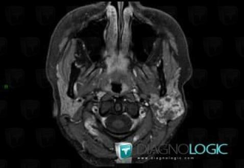 Adénome pléomorphe, Parotide et autres glandes salivaires, IRM