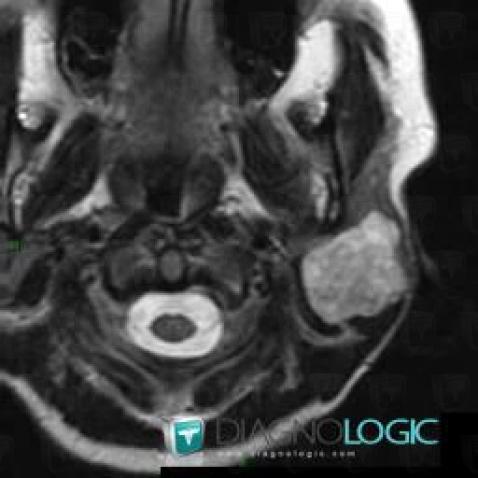 Adénome pléomorphe, Parotide et autres glandes salivaires, IRM