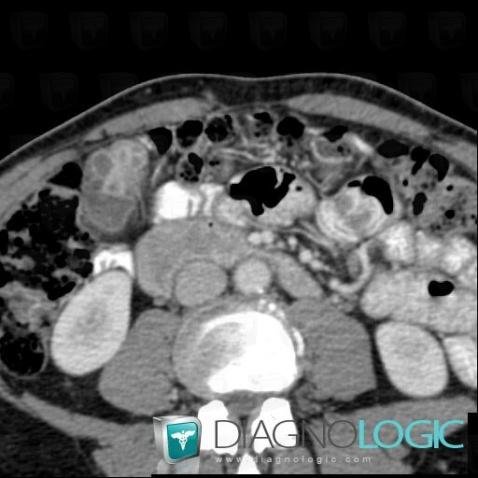 Adenomyomatosis, Gallbladder, CT