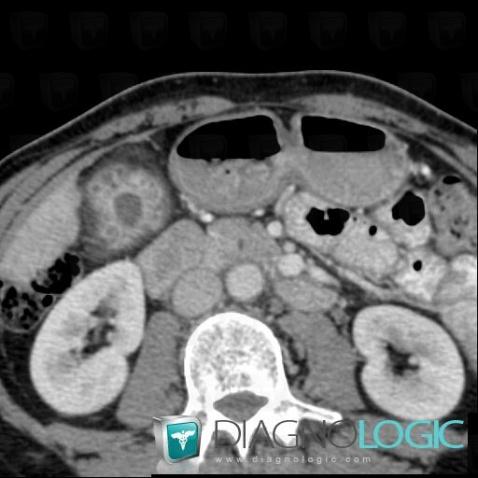 Adenomyomatosis, Gallbladder, CT