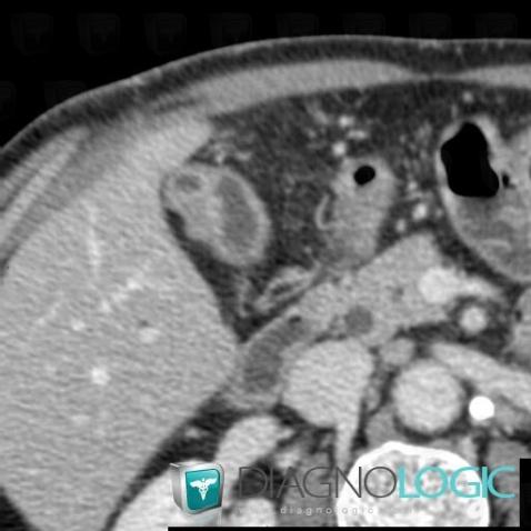 Adenomyomatosis, Gallbladder, CT