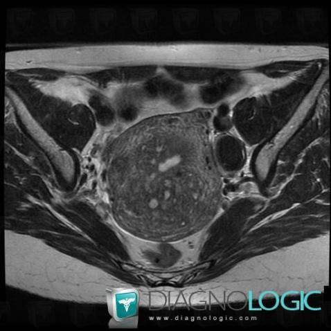 Cas radiologie : Endométriome (IRM) - Diagnologic