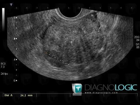 Cas radiologie : Adenomyose (Echographie ,IRM) - Diagnologic