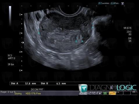 Adenomyose, Utérus, Echographie