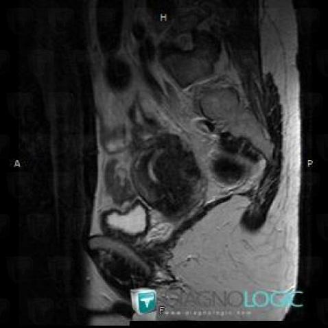 Adenomyose, Utérus, IRM