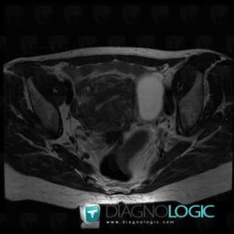 Adenomyosis, Uterus, MRI