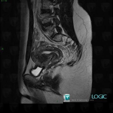 Adenomyosis, Uterus, MRI