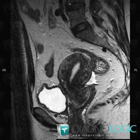 Adenomyosis, Uterus, MRI