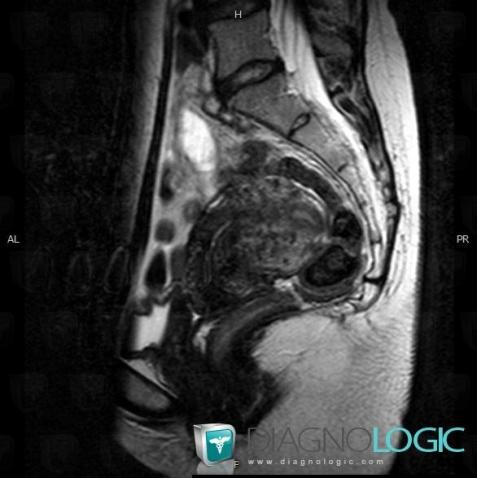 Adenomyosis, Uterus, MRI