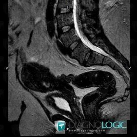 Adenomyosis, Uterus, MRI