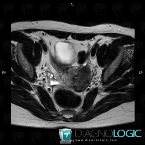 Adenomyosis, Uterus, MRI