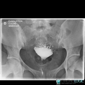 Adenomyosis, Uterus, X rays