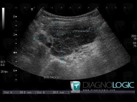 Adénopathie, Espaces profonds-cou, Echographie