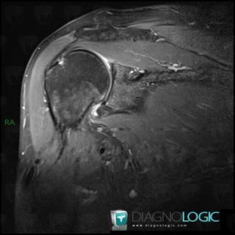 Adhesive capsulitis, Gleno humeral joint, MRI