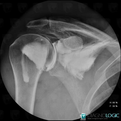 Adhesive capsulitis, Gleno humeral joint, X rays