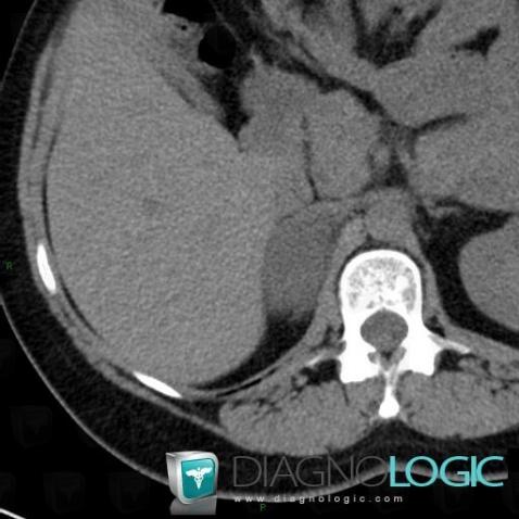 Adrenal hemorrhage, Adrenal glands, CT