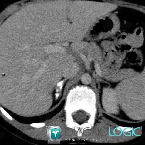 Adrenal hemorrhage, Adrenal glands, CT