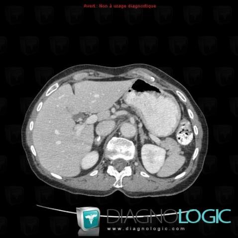 Adrenal hemorrhage, Adrenal glands, CT