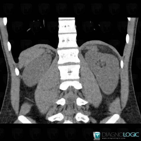 Adrenal insufficiency, Adrenal glands, CT