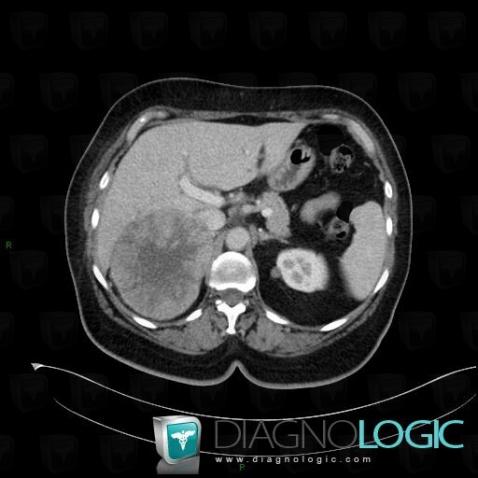 Adrenocortical carcinoma, Adrenal glands, CT