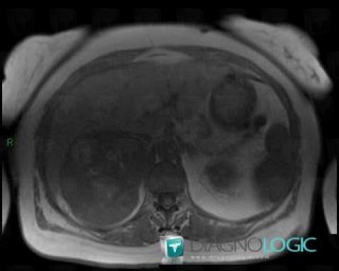 Adrenocortical carcinoma, Adrenal glands, MRI