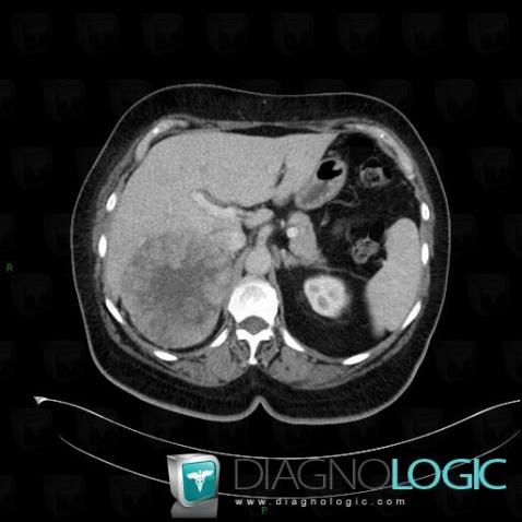 Adrenocortical carcinoma, Retroperitoneum, Adrenal glands, CT