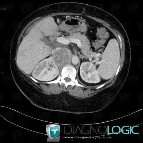 Adrenocortical carcinoma, Retroperitoneum, Adrenal glands, CT