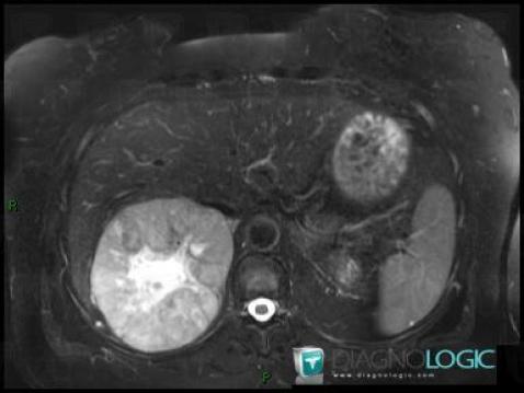 Adrenocortical carcinoma, Retroperitoneum, Adrenal glands, MRI