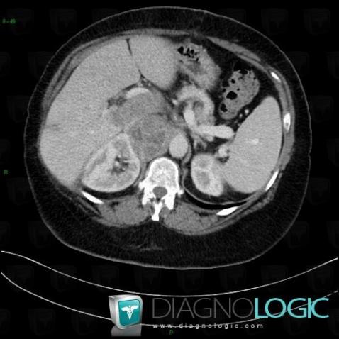 Adrenocortical carcinoma, Retroperitoneum, CT