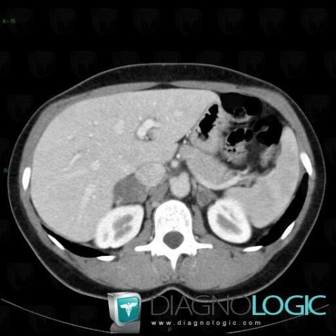 Adrenocortical hyperplasia, Adrenal glands, CT