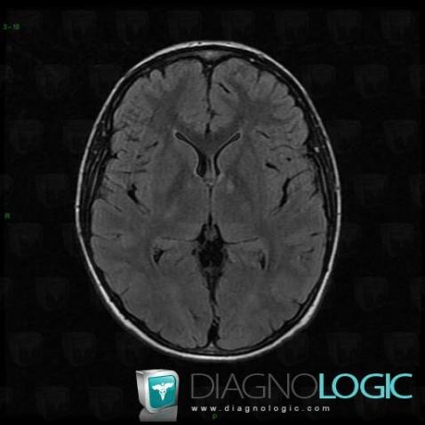 Radiology case : Adrenoleukodystrophy (MRI) - Diagnologic