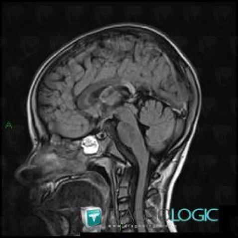 Adrenoleukodystrophy, Corpus callosum, MRI