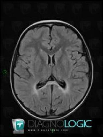 Adrenoleukodystrophy, Ventricles / Periventricular region, MRI