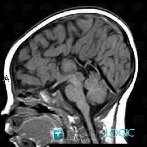 Agenesis-corpus callosum, Cerebral hemispheres, Corpus callosum, MRI