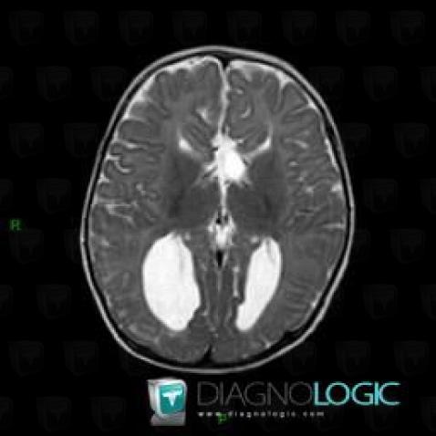 Agenesis-corpus callosum, Cerebral hemispheres, MRI