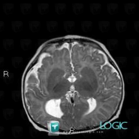 Agenesis-corpus callosum, Cerebral hemispheres, MRI