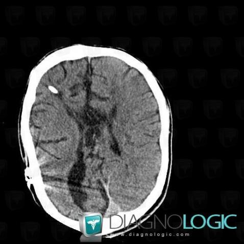 Agenesis-corpus callosum, Corpus callosum, CT