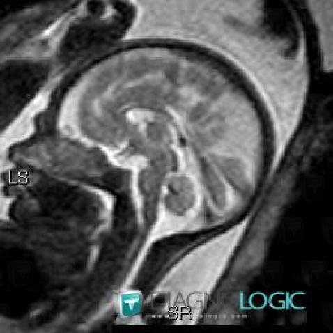 Agenesis-corpus callosum, Corpus callosum, MRI